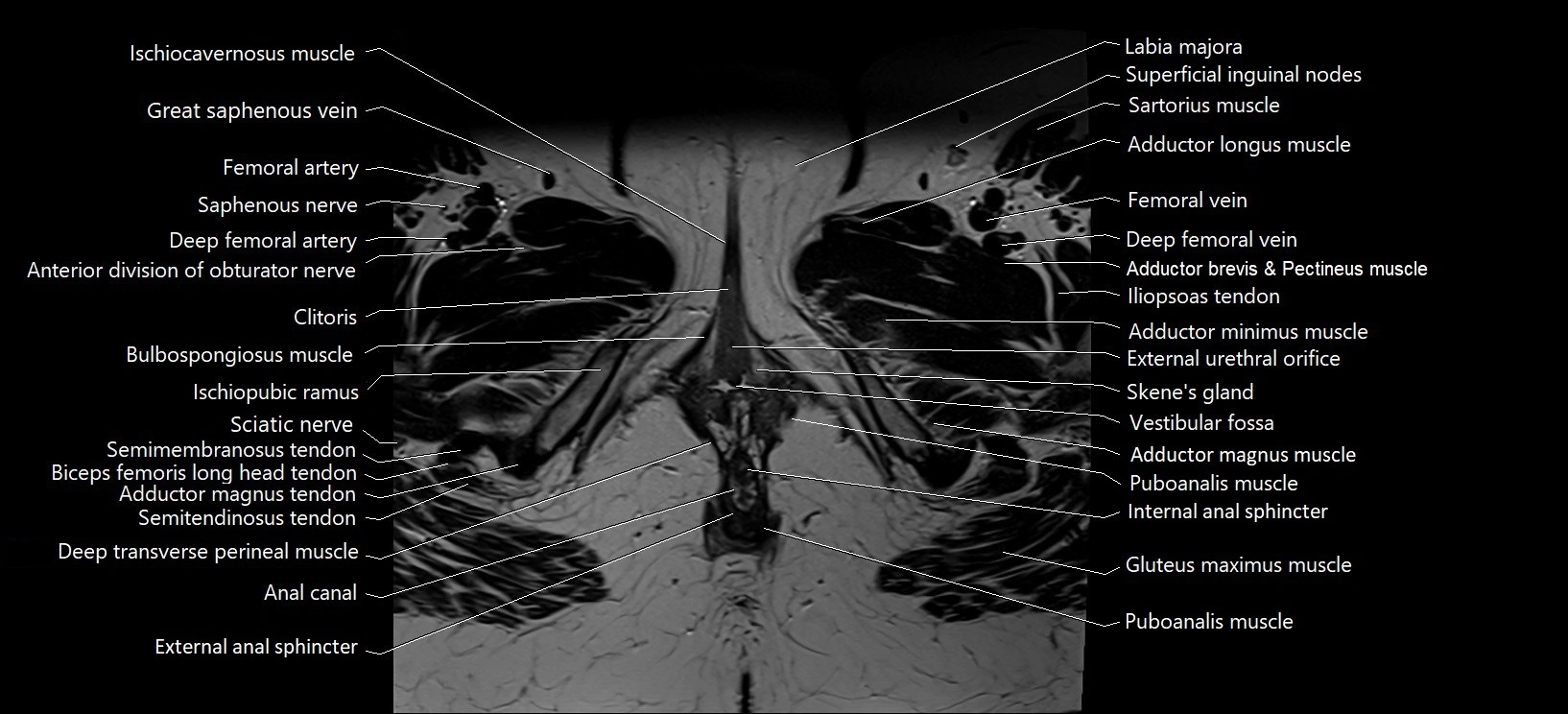 Axial cross sectional anatomy of female pelvis (MRI 3T) image 44.webp